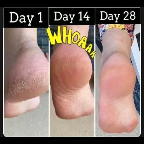 (1) Epoch Foot Treatment Sole solution - Picture 4 of 8